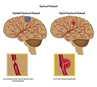 ما هي اعراض جلطة الدماغ – اهم الاعراض التي تصيب بعض الاشخاص من غير ما يشعرون بها