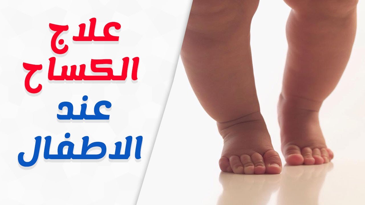 مرض الكساح- كيف تتفادي هذا المرض مع طفلك 5499 1