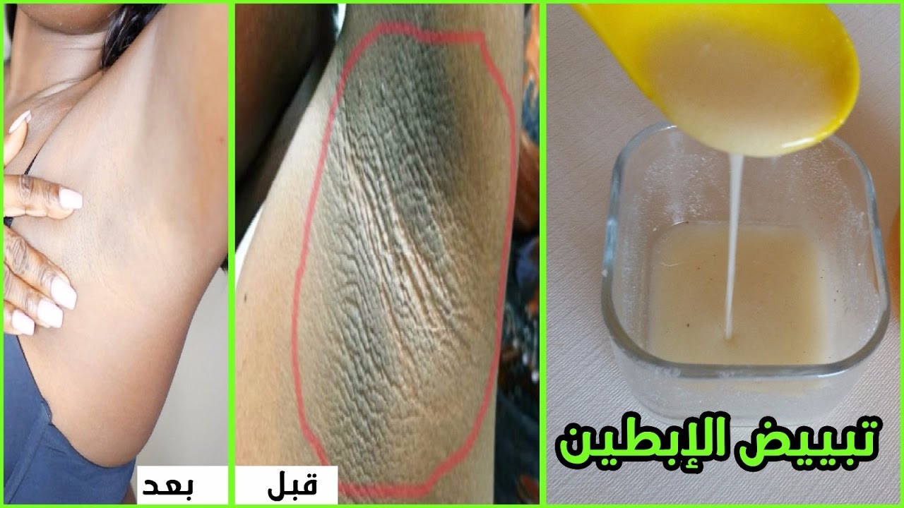 علاج سواد الابط طبيا