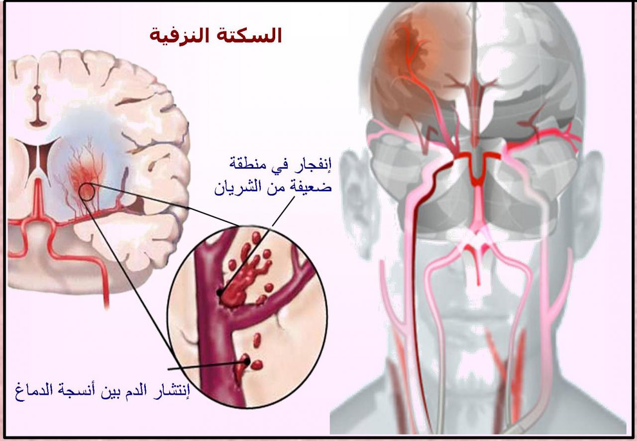 اعراض الجلطة- ازاي تعرف انك داخل على جلطة 5474 2