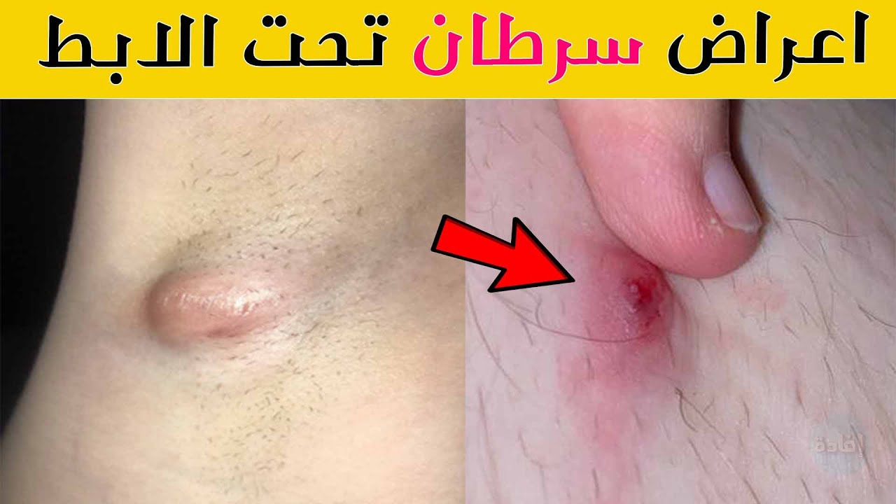 ورم تحت الابط - ماهو علاجه وكيفية التخلص منه 4735 3