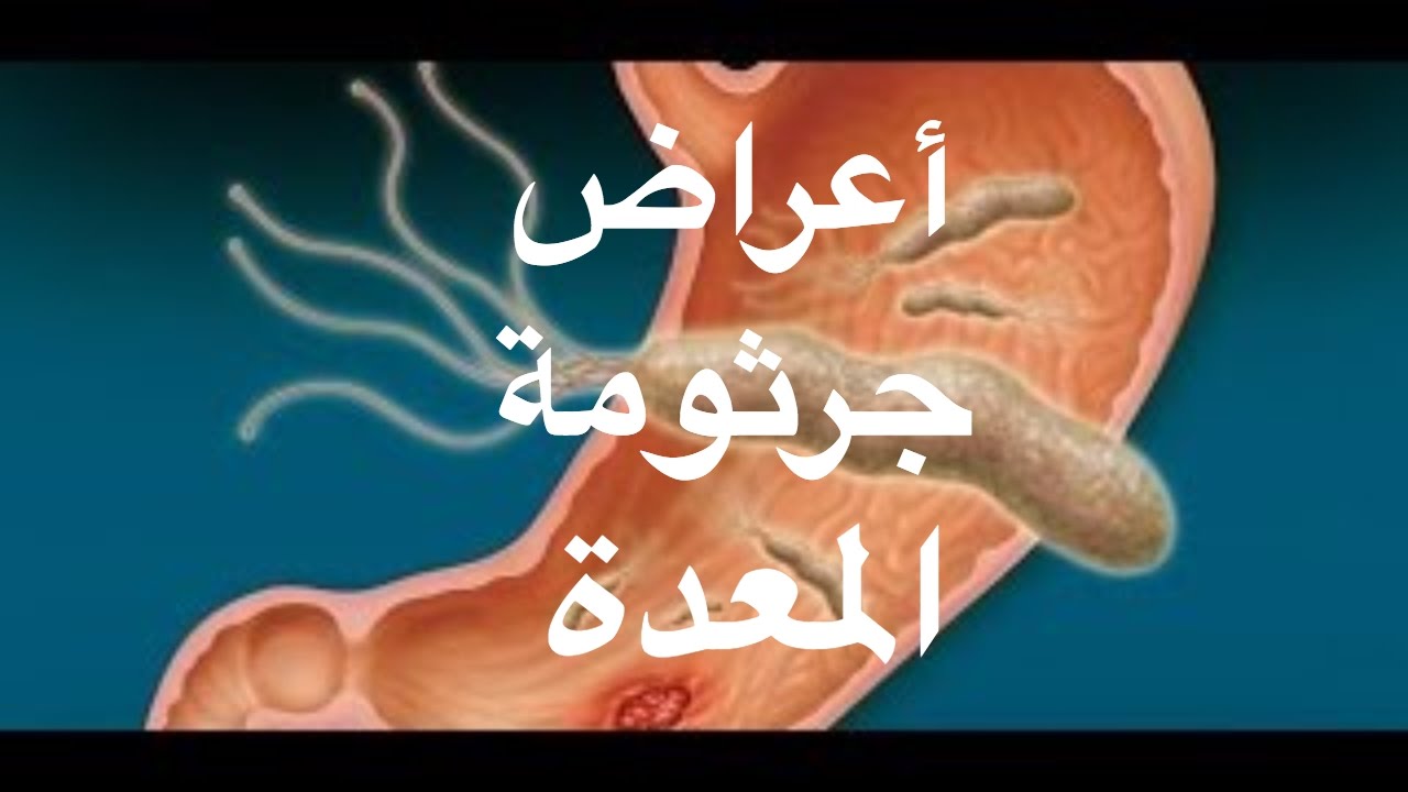 اعراض جرثومة المعدة , مسببات جرثومة المعدة