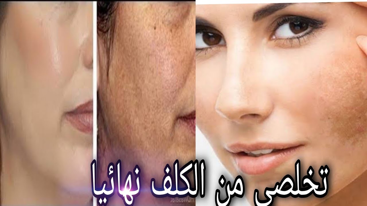 علاج الكلف بالليزر , كيفية التخلص من الكلف