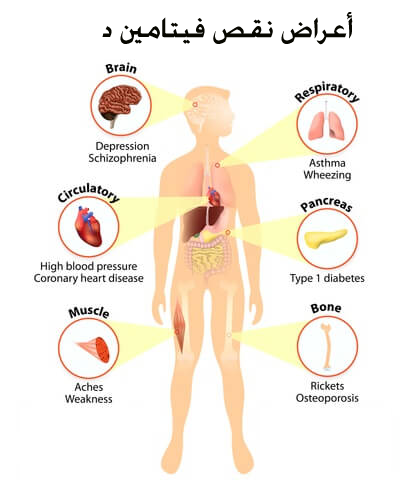 اسباب نقص فيتامين د - اعراض نقص فيتامين د 602