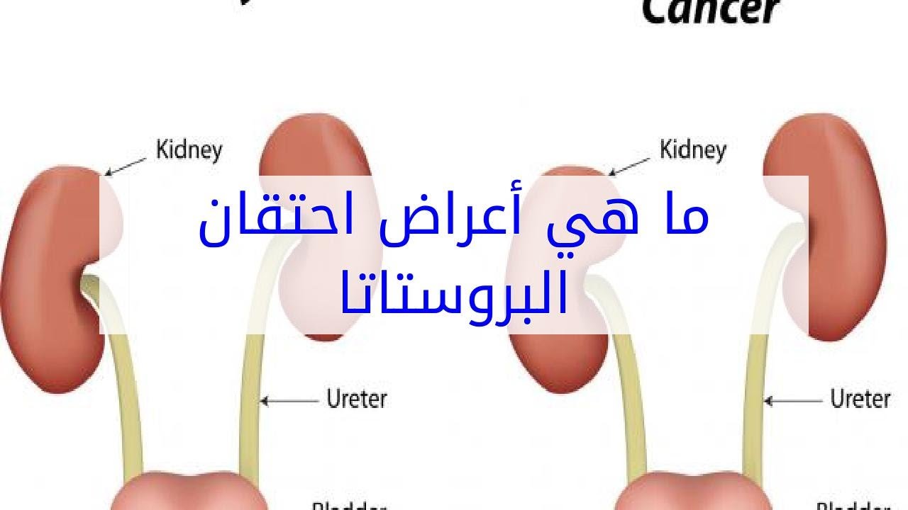 علاج تضخم البروستاتا , البروستاتا وطرق علاجها والوقايه منها