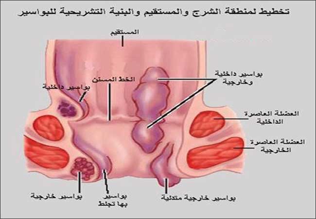 اعراض البواسير - البواسير وما ينتج عنها من اعراض 2817 2