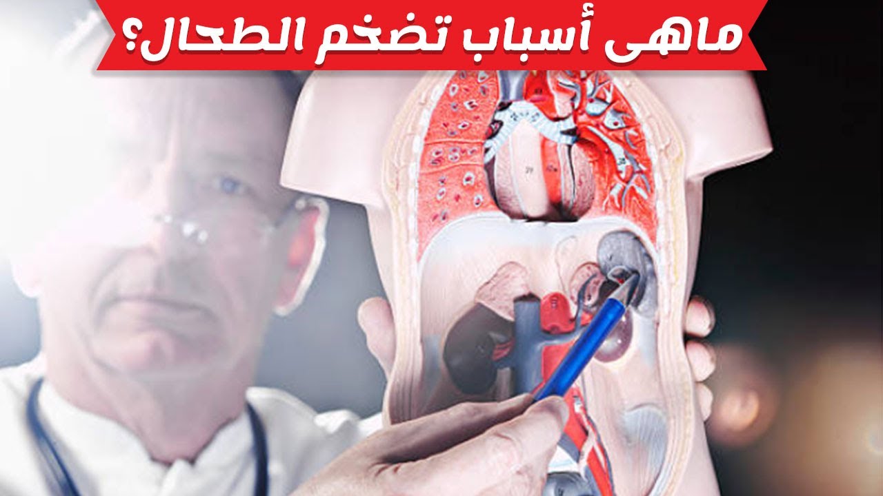 تضخم الطحال 4532 1