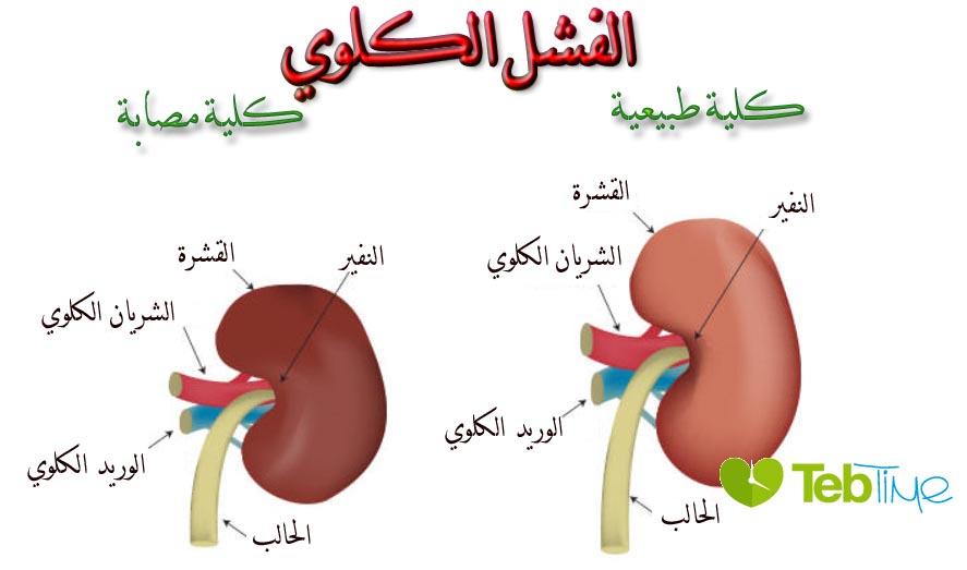 اعراض الفشل الكلوي - اسباب وعلاج الفشل الكلوي 3556