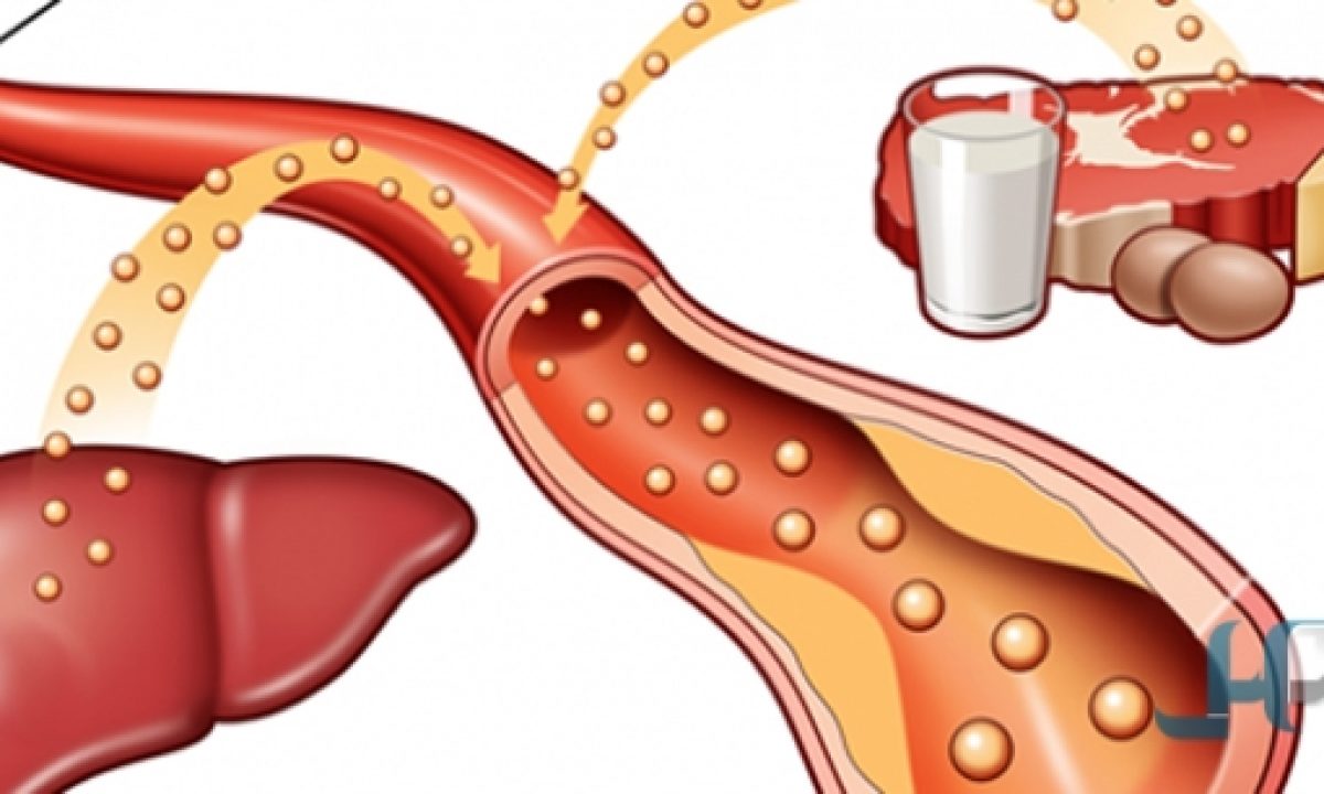 اعراض الكولسترول الضار 10934 5