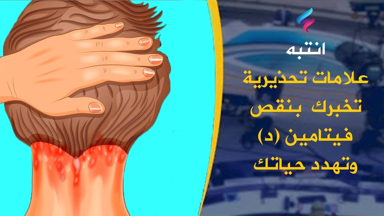 اعراض نقص الكالسيوم وفيتامين د , ماهي اعراضه وكيفية علاجه؟