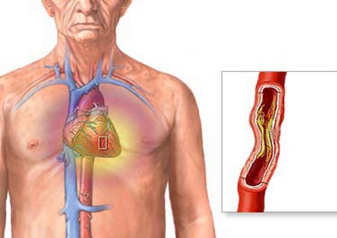 اعراض امراض القلب - ما هى عوارض مرض القلب 422 3