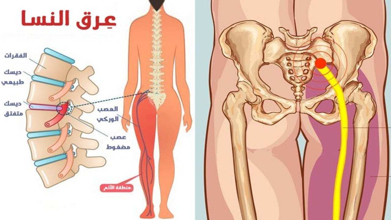 علاج عرق النسا - اسباب وعلاج عرق النسا 575 3