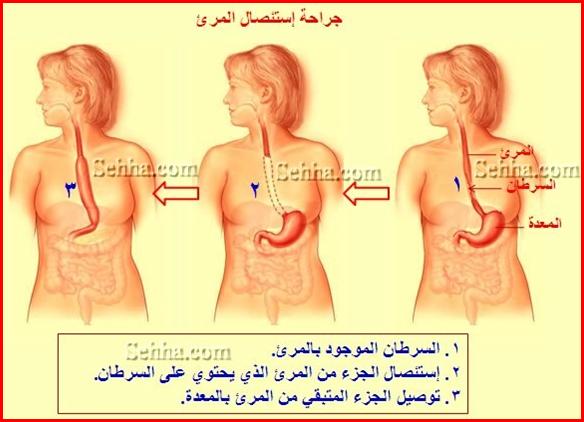 اعراض سرطان المريء , اسباب سرطان المرئ