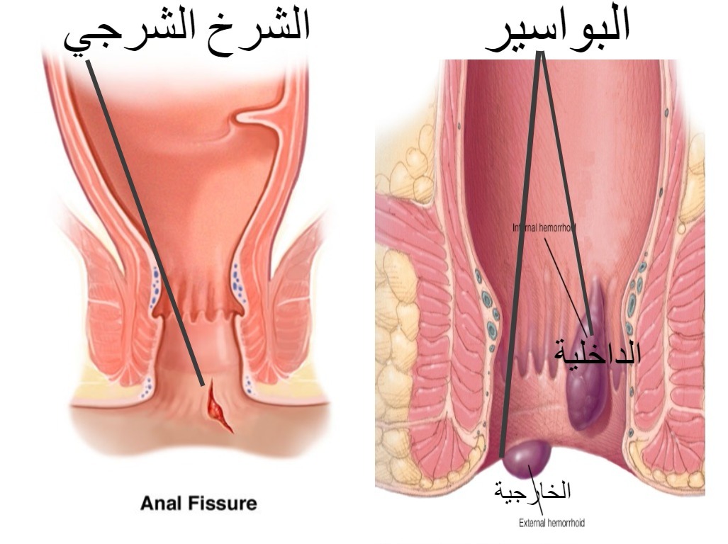 اعراض البواسير - البواسير وما ينتج عنها من اعراض 2817