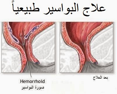 اسباب البواسير , سبب البواسير واعراضها