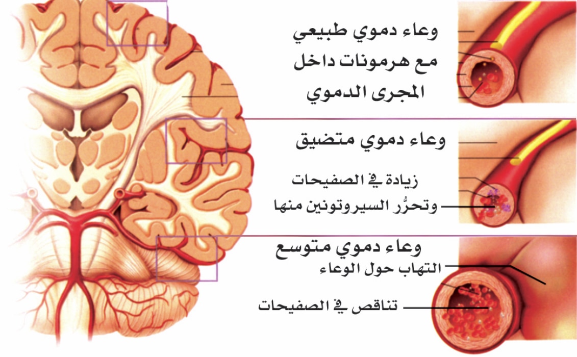 اسباب صداع الراس 11009 2