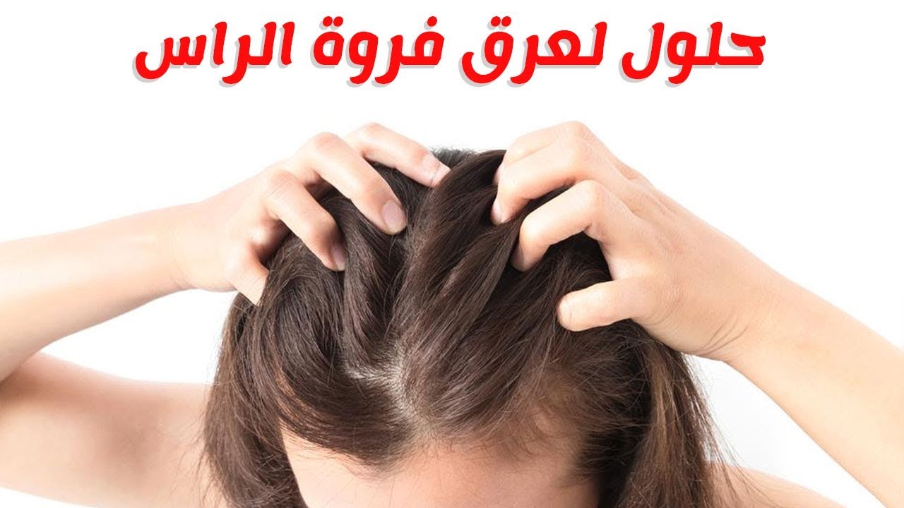 اسباب تعرق الراس , تعرف علي كيفية الحد منها الان