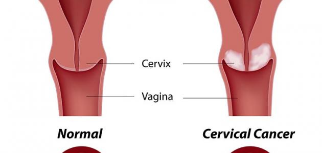 اعراض سرطان الرحم - تعرف ع اعراض الاصابه بسرطان الرحم 101 3