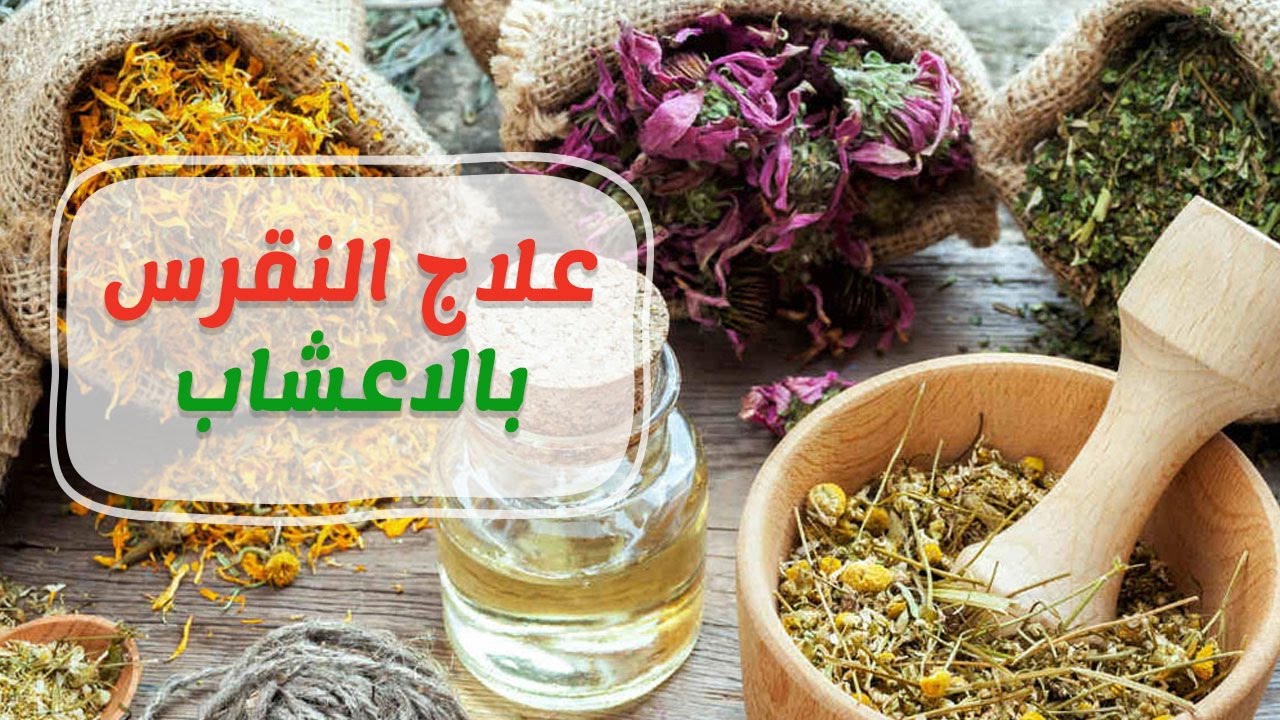 علاج النقرس طبيعيا