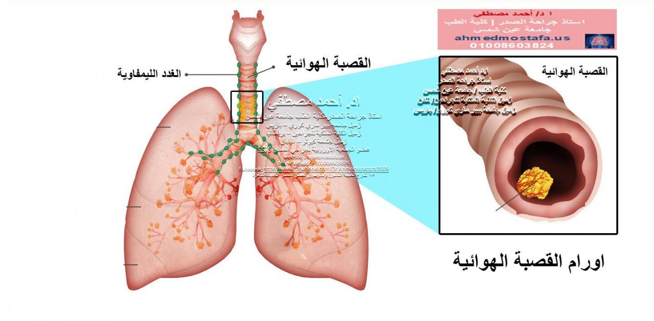 الم القصبة الهوائية 11605