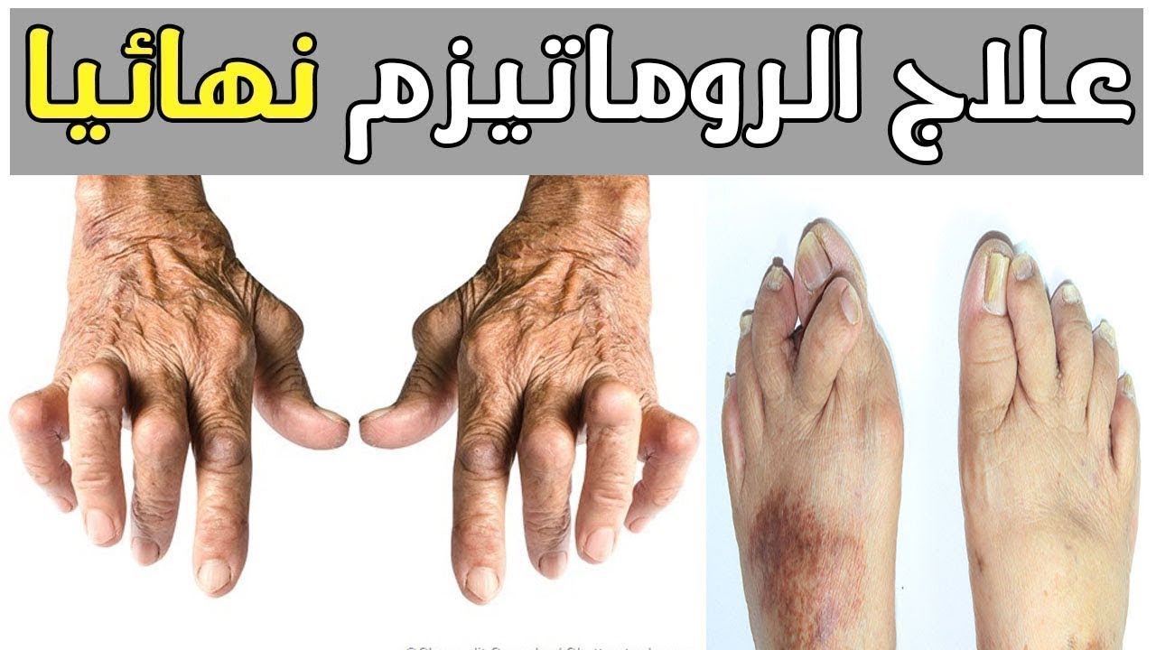 علاج الروماتيزم 4457 3