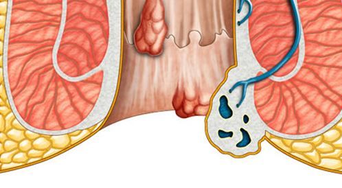 اعراض البواسير - البواسير وما ينتج عنها من اعراض 2817 1