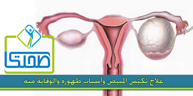 علاج التكيس , ما هى طرق علاج تكيس المبايض